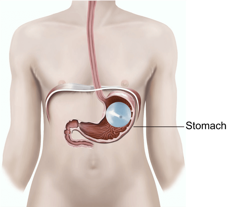 Oral Intragastric Balloon Weight Loss